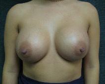 Breast Augmentation After Photo by Constance Barone, MD; San Antonio, TX - Case 9404