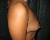 Breast Augmentation Before Photo by Constance Barone, MD; San Antonio, TX - Case 9404