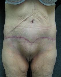 Body Contouring After Photo by Constance Barone, MD; San Antonio, TX - Case 9405