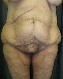 Body Contouring Before Photo by Constance Barone, MD; San Antonio, TX - Case 9405