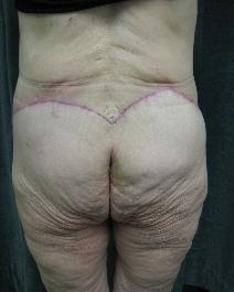 Body Contouring After Photo by Constance Barone, MD; San Antonio, TX - Case 9405