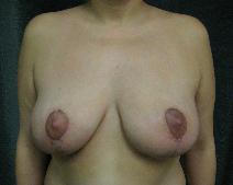 Breast Reduction After Photo by Constance Barone, MD; San Antonio, TX - Case 9407