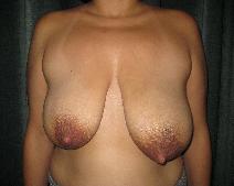 Breast Reduction Before Photo by Constance Barone, MD; San Antonio, TX - Case 9407