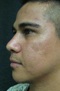 Rhinoplasty After Photo by Constance Barone, MD; San Antonio, TX - Case 9410