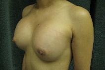 Breast Augmentation After Photo by Constance Barone, MD; San Antonio, TX - Case 9486