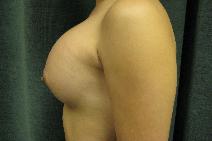 Breast Augmentation After Photo by Constance Barone, MD; San Antonio, TX - Case 9486