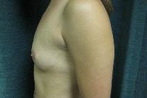 Breast Augmentation Before Photo by Constance Barone, MD; San Antonio, TX - Case 9486