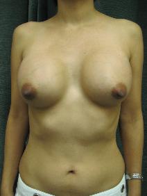 Breast Augmentation After Photo by Constance Barone, MD; San Antonio, TX - Case 9985