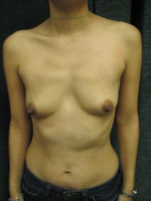 Breast Augmentation Before Photo by Constance Barone, MD; San Antonio, TX - Case 9985