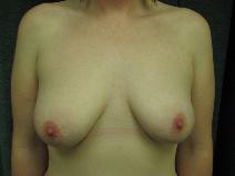 Breast Augmentation Before Photo by Constance Barone, MD; San Antonio, TX - Case 9988