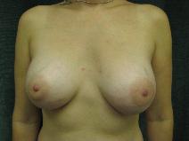 Breast Augmentation After Photo by Constance Barone, MD; San Antonio, TX - Case 9989