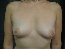 Breast Augmentation Before Photo by Constance Barone, MD; San Antonio, TX - Case 9989
