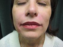 Dermal Fillers After Photo by Constance Barone, MD; San Antonio, TX - Case 9991