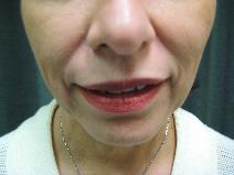 Dermal Fillers Before Photo by Constance Barone, MD; San Antonio, TX - Case 9991