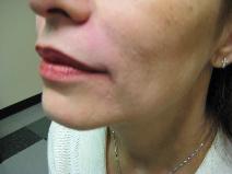 Dermal Fillers After Photo by Constance Barone, MD; San Antonio, TX - Case 9991