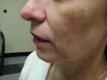 Dermal Fillers Before Photo by Constance Barone, MD; San Antonio, TX - Case 9991