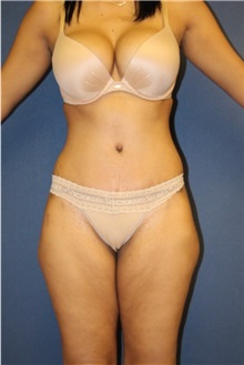 Tummy Tuck After Photo by Laurence Glickman, MD, MSc, FRCS(c),  FACS; Garden City, NY - Case 27988