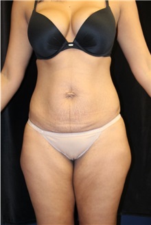 Tummy Tuck Before Photo by Laurence Glickman, MD, MSc, FRCS(c),  FACS; Garden City, NY - Case 27988