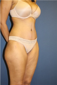 Tummy Tuck After Photo by Laurence Glickman, MD, MSc, FRCS(c),  FACS; Garden City, NY - Case 27988