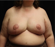Breast Reduction After Photo by Laurence Glickman, MD, MSc, FRCS(c),  FACS; Garden City, NY - Case 27989