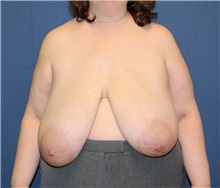 Breast Reduction Before Photo by Laurence Glickman, MD, MSc, FRCS(c),  FACS; Garden City, NY - Case 27989