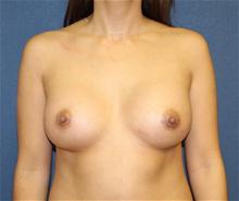 Breast Augmentation After Photo by Laurence Glickman, MD, MSc, FRCS(c),  FACS; Garden City, NY - Case 27990