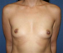 Breast Augmentation Before Photo by Laurence Glickman, MD, MSc, FRCS(c),  FACS; Garden City, NY - Case 27990