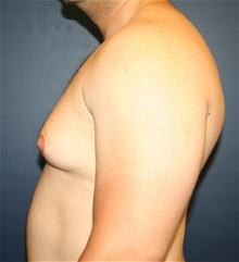 Male Breast Reduction Before Photo by Laurence Glickman, MD, MSc, FRCS(c),  FACS; Garden City, NY - Case 27991