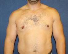 Male Breast Reduction After Photo by Laurence Glickman, MD, MSc, FRCS(c),  FACS; Garden City, NY - Case 27991