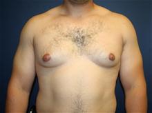 Male Breast Reduction Before Photo by Laurence Glickman, MD, MSc, FRCS(c),  FACS; Garden City, NY - Case 27991