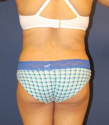 Liposuction After Photo by Laurence Glickman, MD, MSc, FRCS(c),  FACS; Garden City, NY - Case 27992