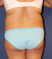 Liposuction Before Photo by Laurence Glickman, MD, MSc, FRCS(c),  FACS; Garden City, NY - Case 27992