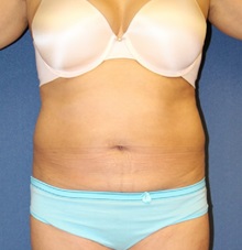 Tummy Tuck Before Photo by Laurence Glickman, MD, MSc, FRCS(c),  FACS; Garden City, NY - Case 27993