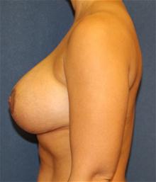 Breast Augmentation After Photo by Laurence Glickman, MD, MSc, FRCS(c),  FACS; Garden City, NY - Case 27994
