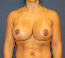 Breast Augmentation After Photo by Laurence Glickman, MD, MSc, FRCS(c),  FACS; Garden City, NY - Case 27994