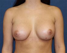 Breast Augmentation After Photo by Laurence Glickman, MD, MSc, FRCS(c),  FACS; Garden City, NY - Case 27995