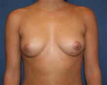 Breast Augmentation Before Photo by Laurence Glickman, MD, MSc, FRCS(c),  FACS; Garden City, NY - Case 27995