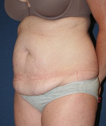 Tummy Tuck Before Photo by Laurence Glickman, MD, MSc, FRCS(c),  FACS; Garden City, NY - Case 27996