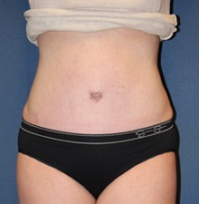 Tummy Tuck After Photo by Laurence Glickman, MD, MSc, FRCS(c),  FACS; Garden City, NY - Case 27996