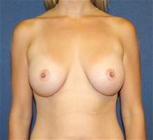 Breast Augmentation After Photo by Laurence Glickman, MD, MSc, FRCS(c),  FACS; Garden City, NY - Case 27997