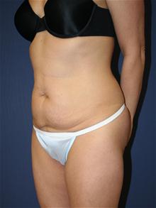 Tummy Tuck Before Photo by Laurence Glickman, MD, MSc, FRCS(c),  FACS; Garden City, NY - Case 27998