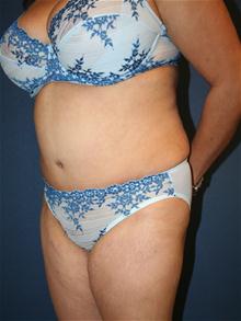 Tummy Tuck After Photo by Laurence Glickman, MD, MSc, FRCS(c),  FACS; Garden City, NY - Case 27999