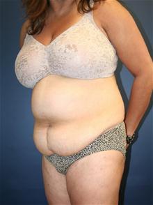 Tummy Tuck Before Photo by Laurence Glickman, MD, MSc, FRCS(c),  FACS; Garden City, NY - Case 27999