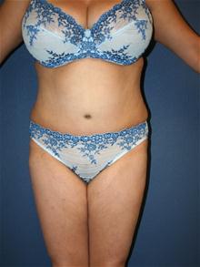 Tummy Tuck After Photo by Laurence Glickman, MD, MSc, FRCS(c),  FACS; Garden City, NY - Case 27999