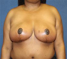 Breast Reduction After Photo by Laurence Glickman, MD, MSc, FRCS(c),  FACS; Garden City, NY - Case 28000
