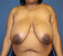 Breast Reduction Before Photo by Laurence Glickman, MD, MSc, FRCS(c),  FACS; Garden City, NY - Case 28000