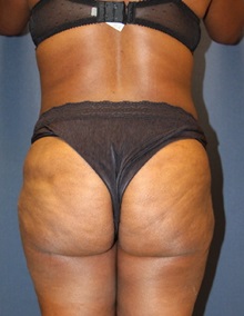 Liposuction After Photo by Laurence Glickman, MD, MSc, FRCS(c),  FACS; Garden City, NY - Case 28003