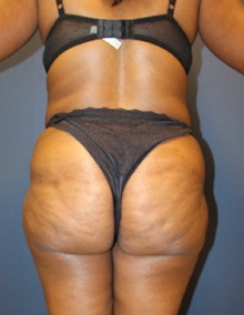Liposuction Before Photo by Laurence Glickman, MD, MSc, FRCS(c),  FACS; Garden City, NY - Case 28003
