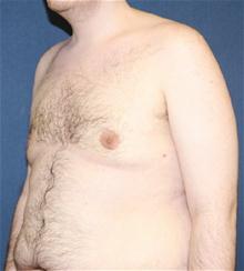 Male Breast Reduction After Photo by Laurence Glickman, MD, MSc, FRCS(c),  FACS; Garden City, NY - Case 28004