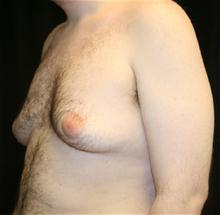 Male Breast Reduction Before Photo by Laurence Glickman, MD, MSc, FRCS(c),  FACS; Garden City, NY - Case 28004